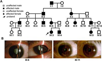 Identification of a New Mutation p.P88L in Connexin 50 Associated with Dominant Congenital Cataract